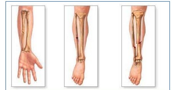 Detail Gambar Fraktura Sederhana Nomer 10
