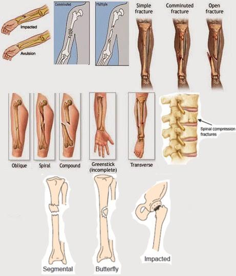 Detail Gambar Fraktura Sederhana Nomer 11