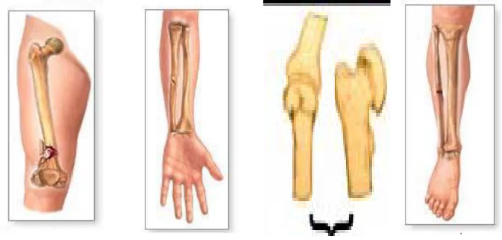 Detail Gambar Fraktura Sederhana Nomer 29