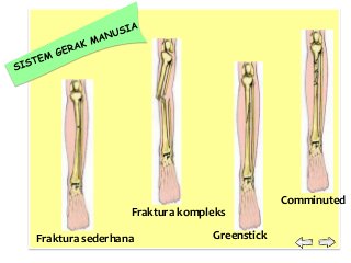 Detail Gambar Fraktura Sederhana Nomer 30