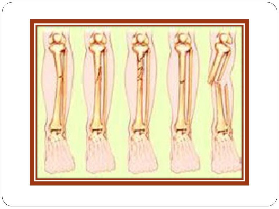 Detail Gambar Fraktura Sederhana Nomer 33