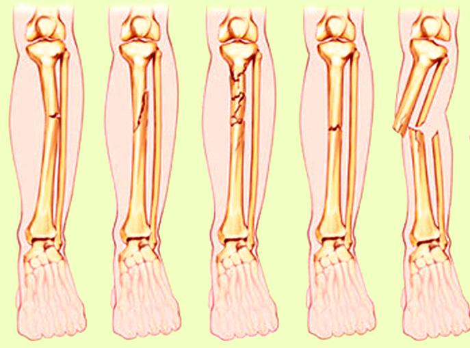 Detail Gambar Fraktura Sederhana Nomer 4