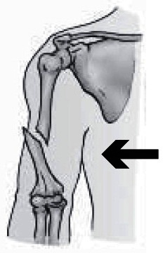 Detail Gambar Fraktura Sederhana Nomer 5