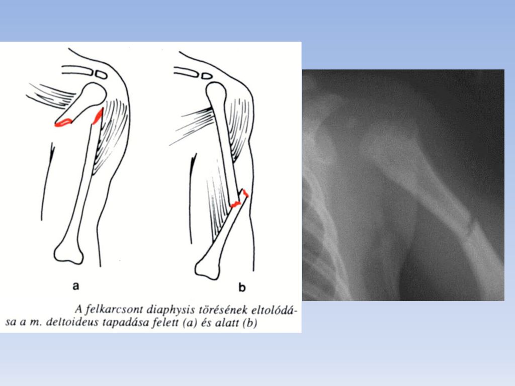 Detail Gambar Fraktura Sederhana Nomer 42