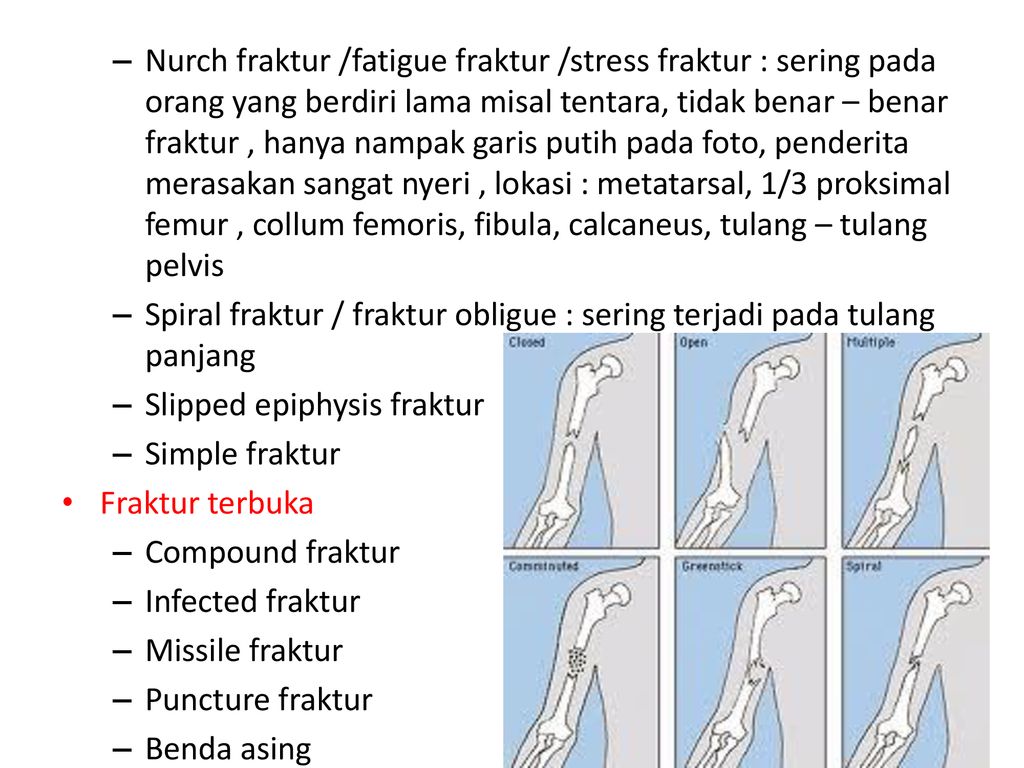 Detail Gambar Fraktura Sederhana Nomer 47