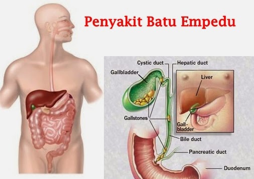 Download Gambar Gambar Batu Empedu Nomer 2