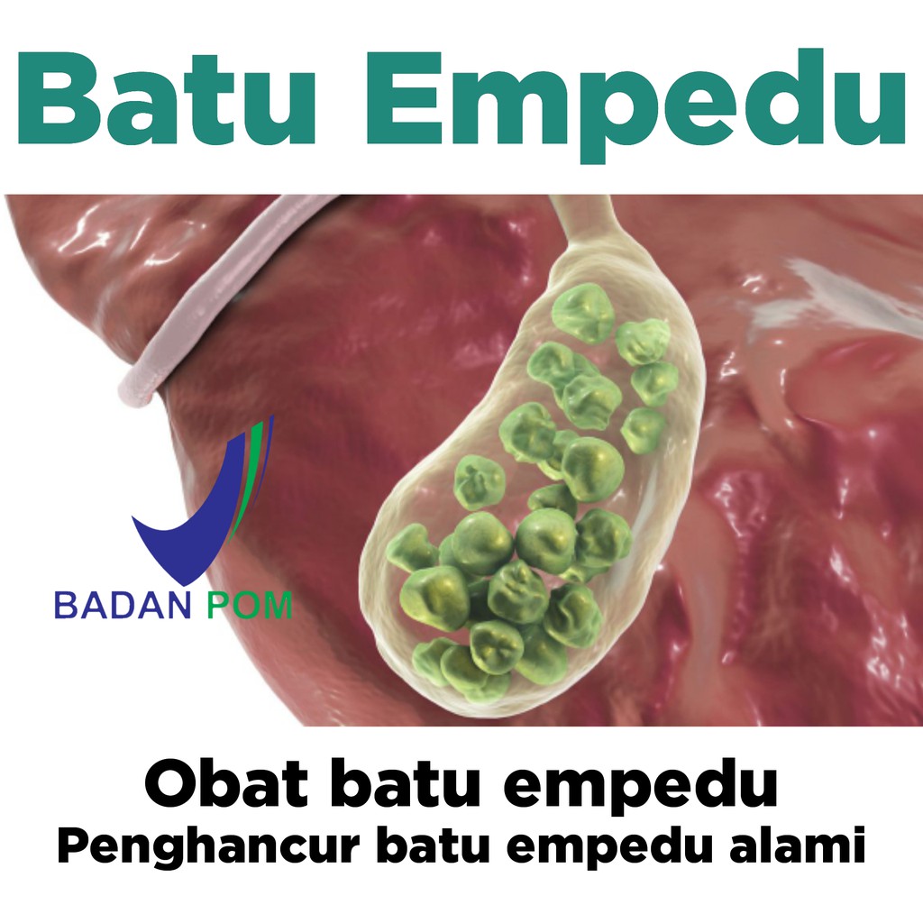 Detail Gambar Gambar Batu Empedu Nomer 21