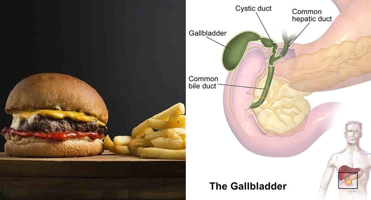 Detail Gambar Gambar Batu Empedu Nomer 26