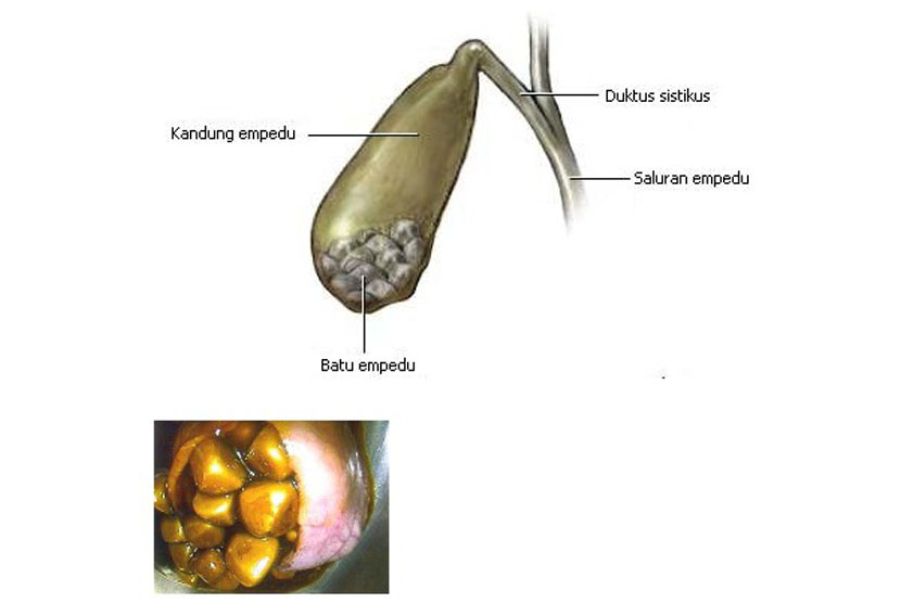 Detail Gambar Gambar Batu Empedu Nomer 44