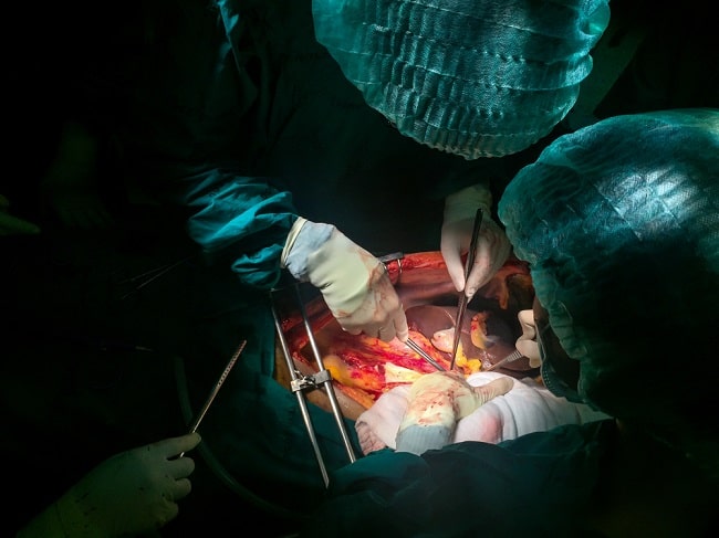 Detail Gambar Gambar Transplantasi Organ Nomer 9