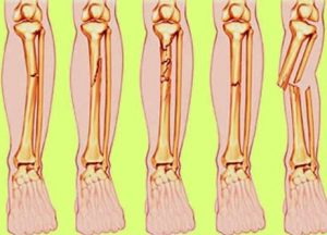 Detail Gambar Gangguan Dan Kelainan Pada Tulang Nomer 12