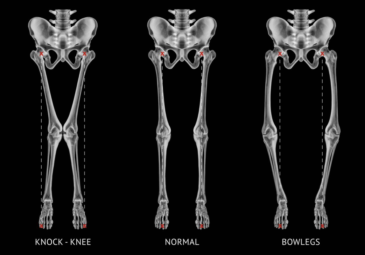 Detail Gambar Gangguan Dan Kelainan Pada Tulang Nomer 36