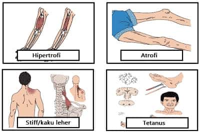 Detail Gambar Gangguan Dan Kelainan Pada Tulang Nomer 39