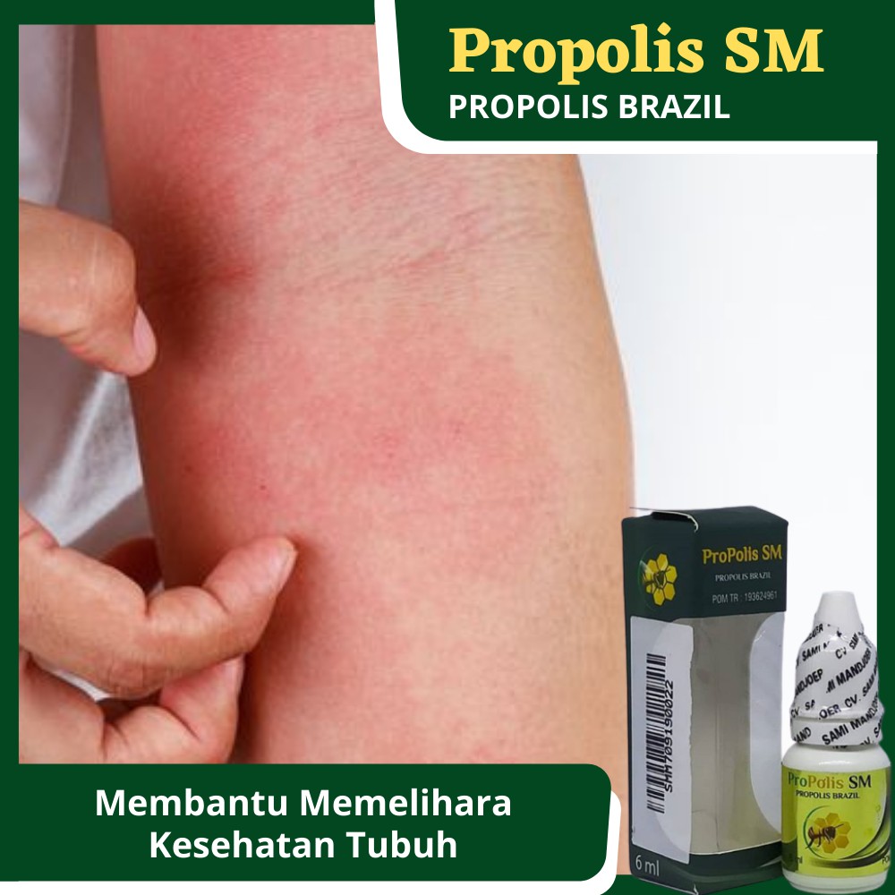 Detail Gambar Gatal Pada Kulit Nomer 27