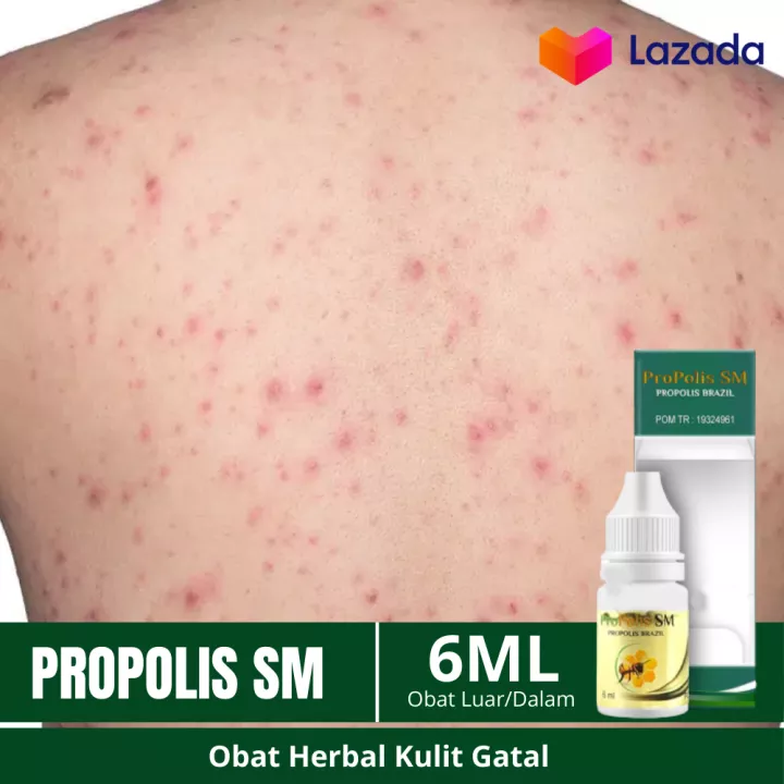 Detail Gambar Gatal Pada Kulit Nomer 39