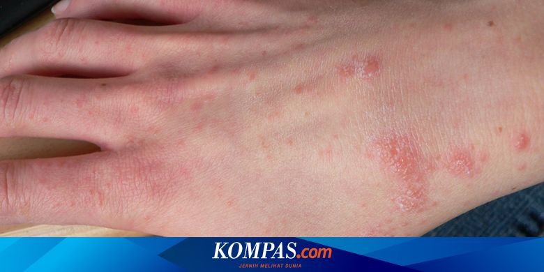 Detail Gambar Gatal Pada Kulit Nomer 44