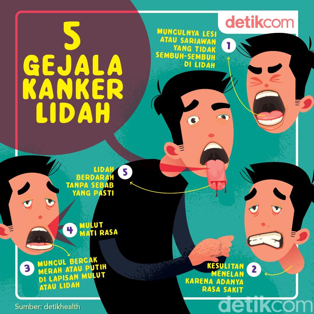 Detail Gambar Gejala Awal Kanker Lidah Nomer 21