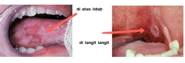 Detail Gambar Gejala Awal Kanker Lidah Nomer 39