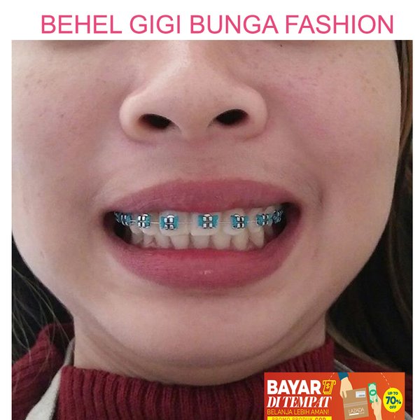 Detail Gambar Gigi Behel Nomer 42