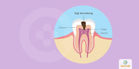 Detail Gambar Gigi Berlubang Nomer 19