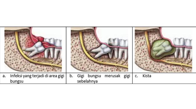 Detail Gambar Gigi Bungsu Nomer 24