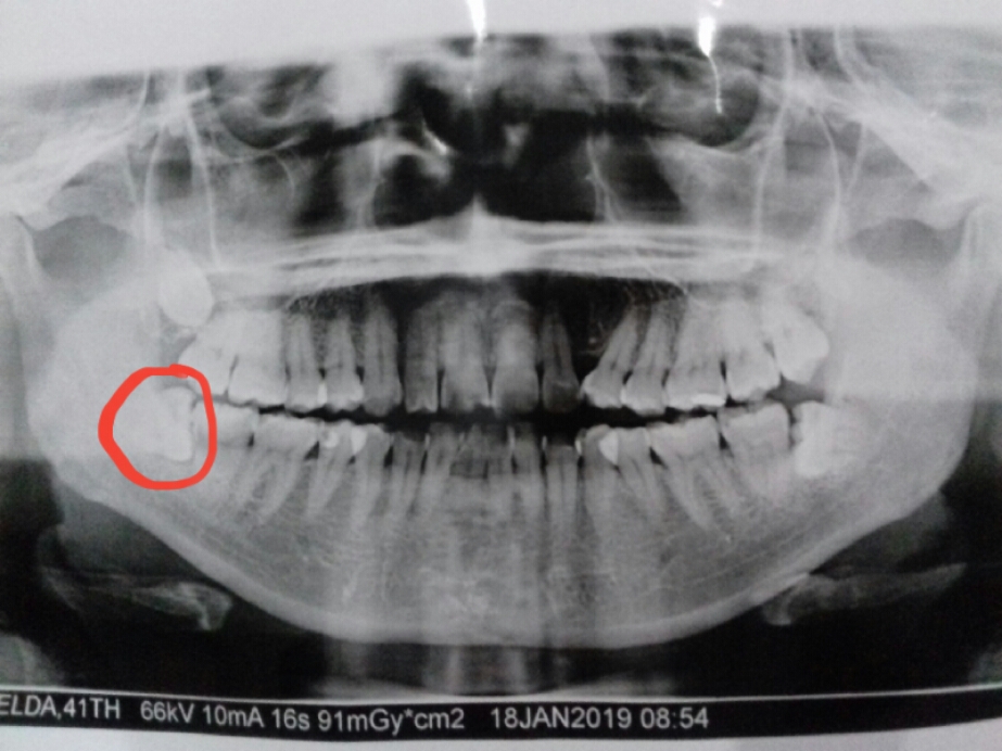 Detail Gambar Gigi Bungsu Nomer 46