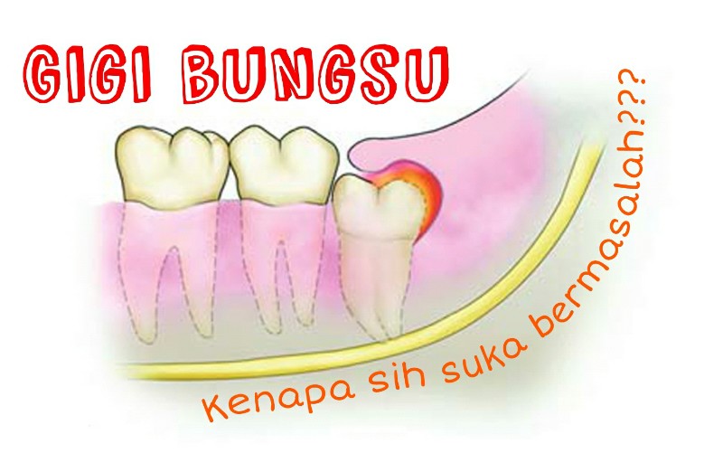 Detail Gambar Gigi Bungsu Tumbuh Nomer 48