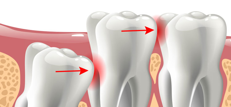 Detail Gambar Gigi Bungsu Tumbuh Miring Nomer 51