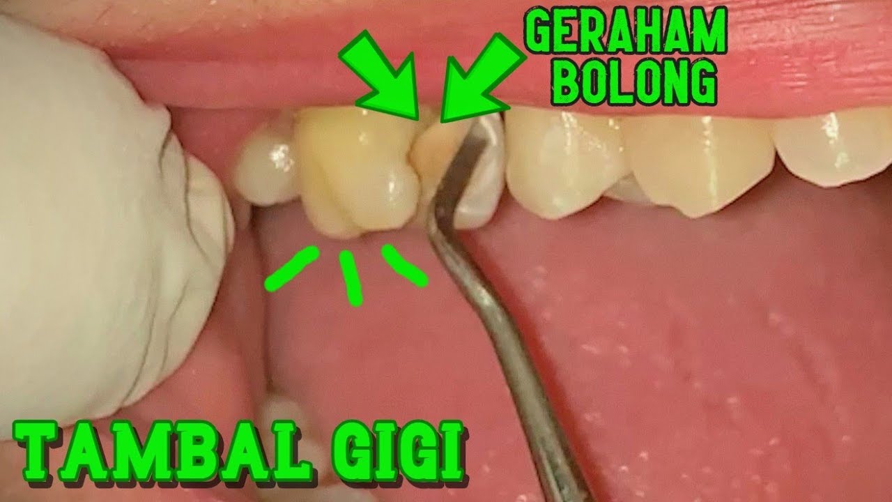 Detail Gambar Gigi Geraham Atas Nomer 12