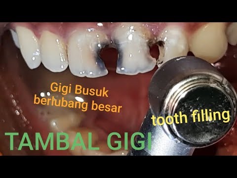 Detail Gambar Gigi Keropos Nomer 34