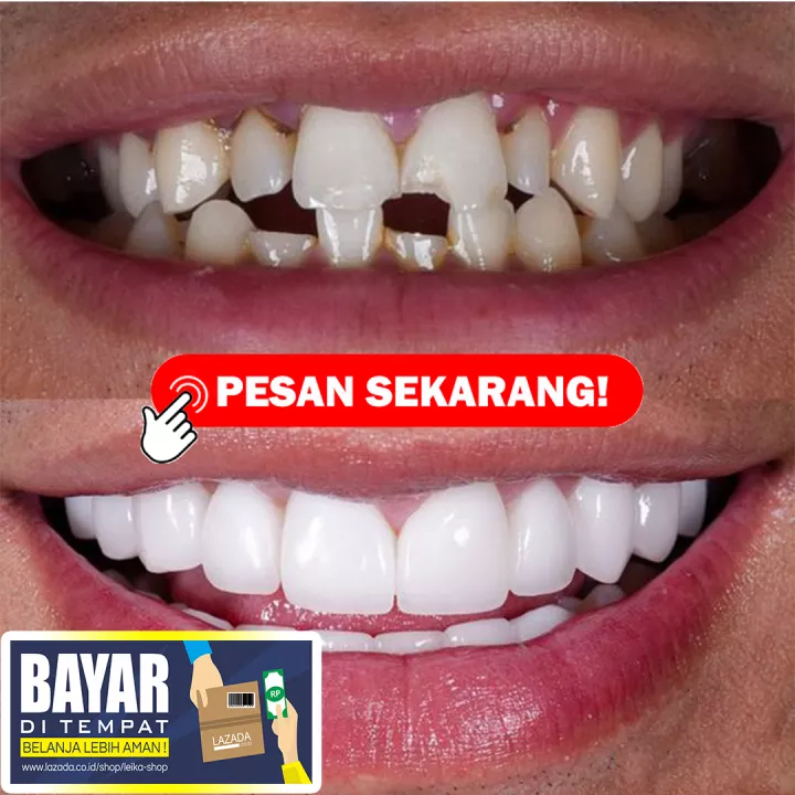 Detail Gambar Gigi Ompong Depan Nomer 22