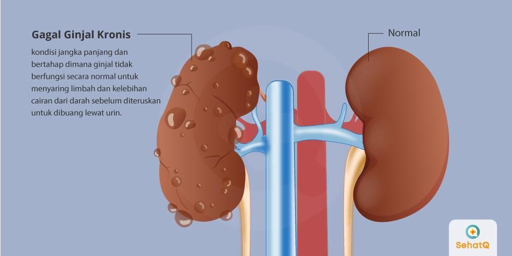 Detail Gambar Ginjal Yang Sehat Nomer 27