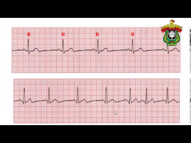 Detail Gambar Grafik Ekg Nomer 14