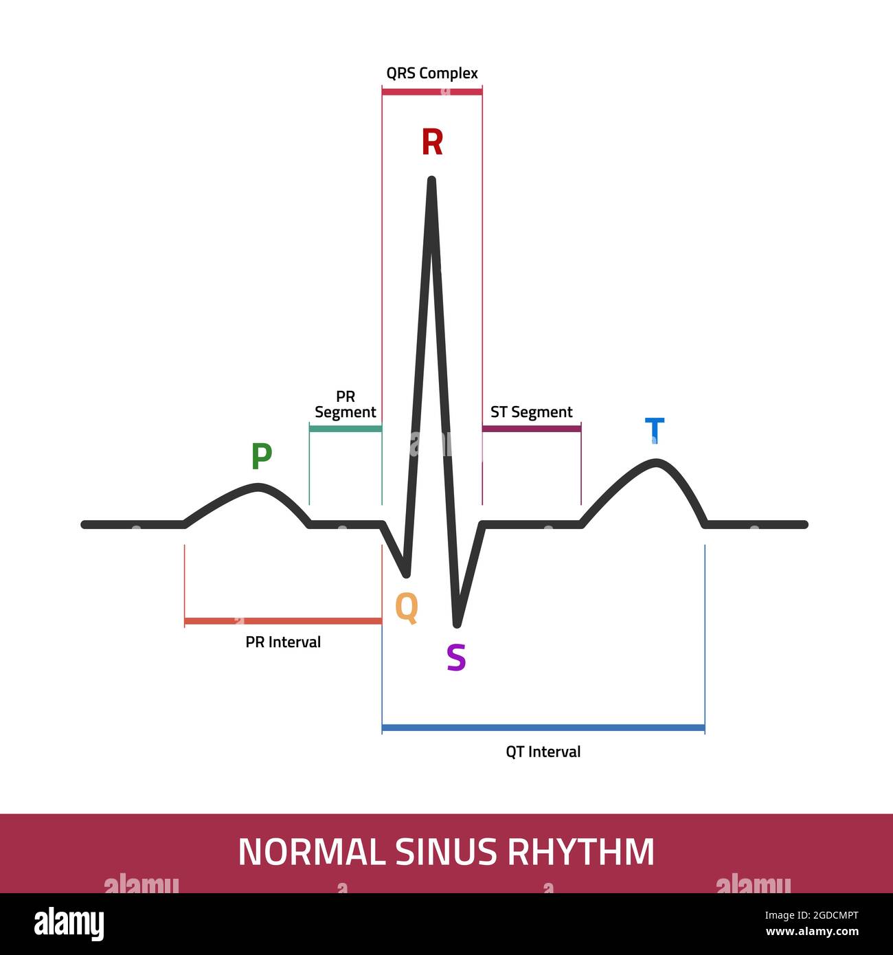 Detail Gambar Grafik Ekg Nomer 17