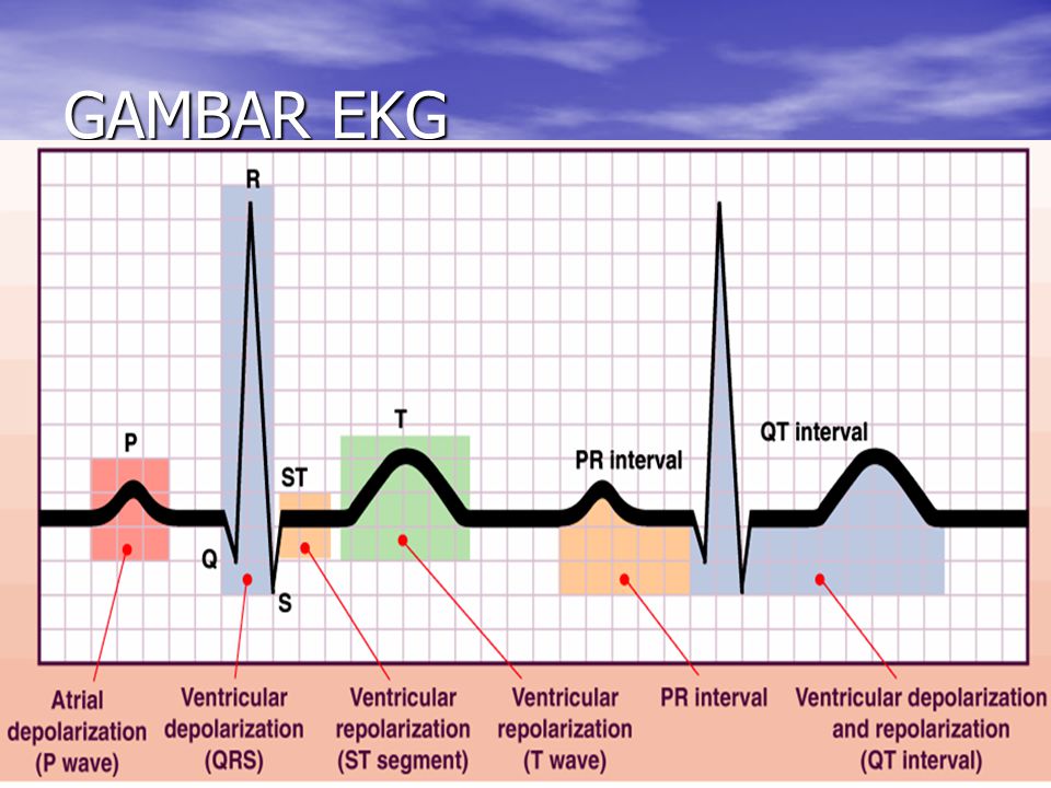 Detail Gambar Grafik Ekg Nomer 18