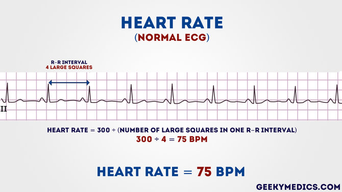 Detail Gambar Grafik Ekg Nomer 4