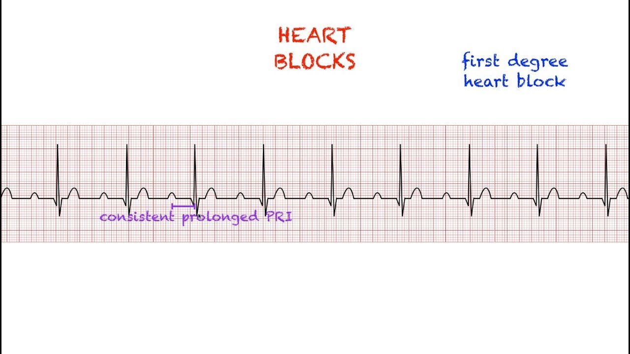 Detail Gambar Grafik Ekg Nomer 40