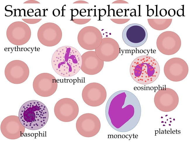 Detail Gambaran Darah Tepi Anemia Nomer 3