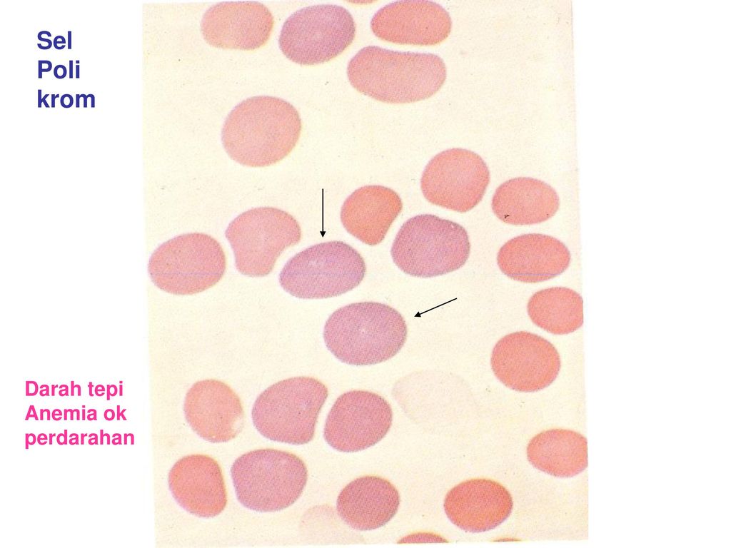 Detail Gambaran Darah Tepi Anemia Nomer 22