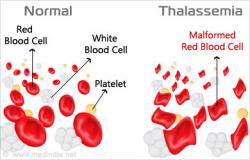 Detail Gambaran Darah Tepi Thalasemia Nomer 11