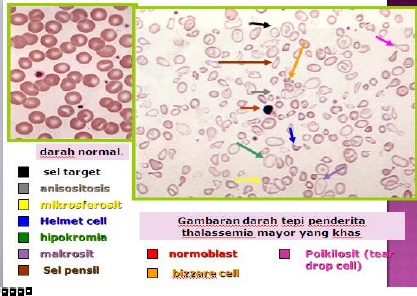 Detail Gambaran Darah Tepi Thalasemia Nomer 26