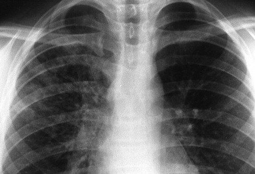 Detail Gambaran Foto Thorax Pneumonia Nomer 11