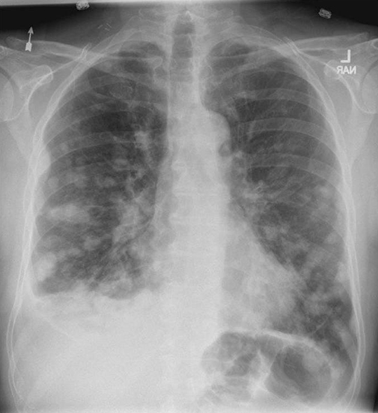 Detail Gambaran Foto Thorax Pneumonia Nomer 13