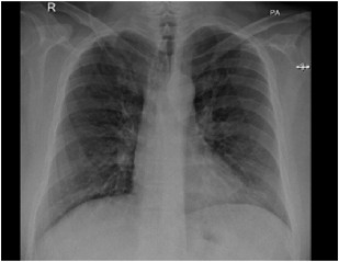 Detail Gambaran Foto Thorax Pneumonia Nomer 14