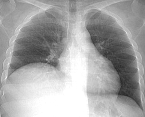 Detail Gambaran Foto Thorax Pneumonia Nomer 20