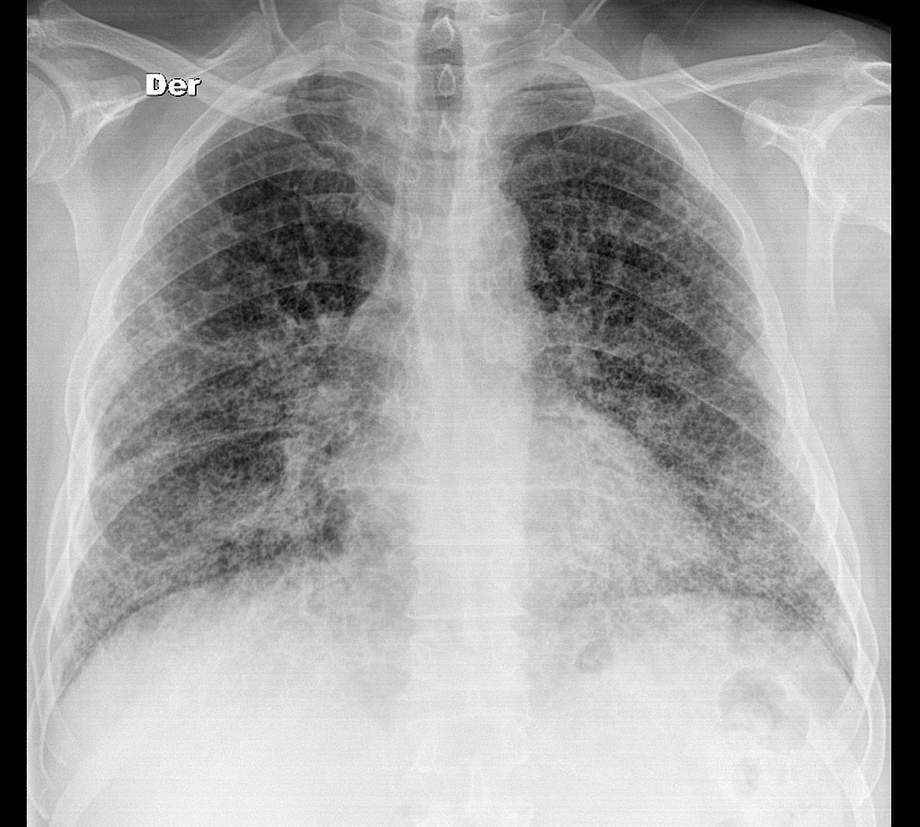 Detail Gambaran Foto Thorax Pneumonia Nomer 3