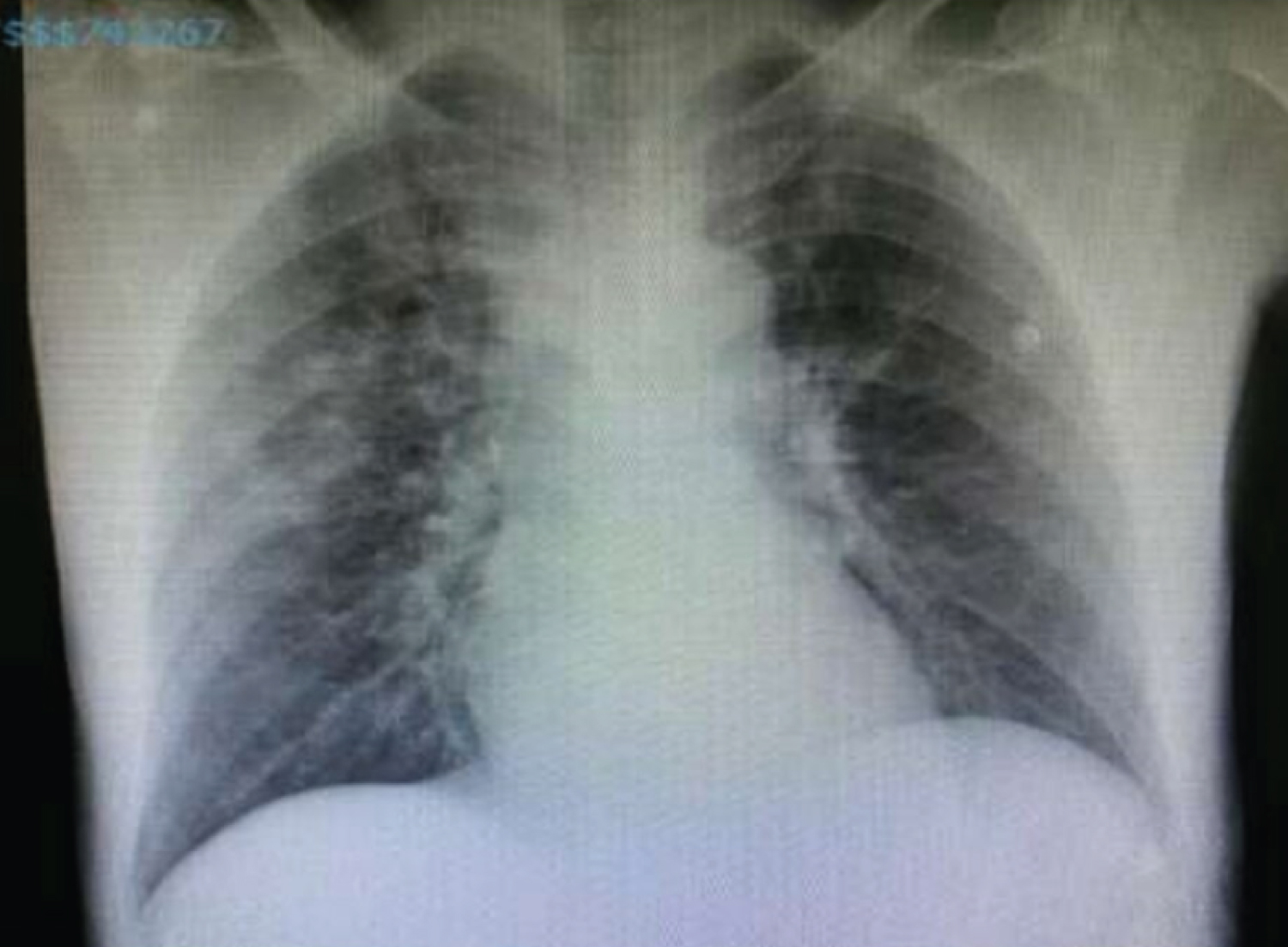 Detail Gambaran Foto Thorax Pneumonia Nomer 24