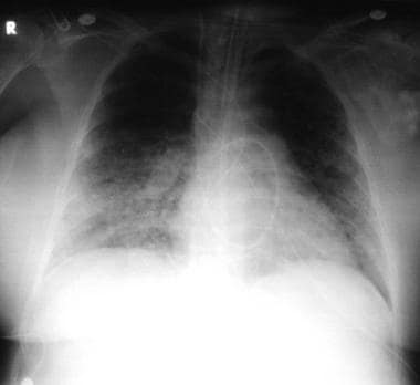 Detail Gambaran Foto Thorax Pneumonia Nomer 25