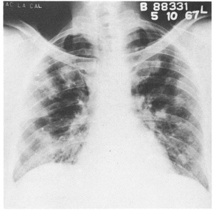 Detail Gambaran Foto Thorax Pneumonia Nomer 27
