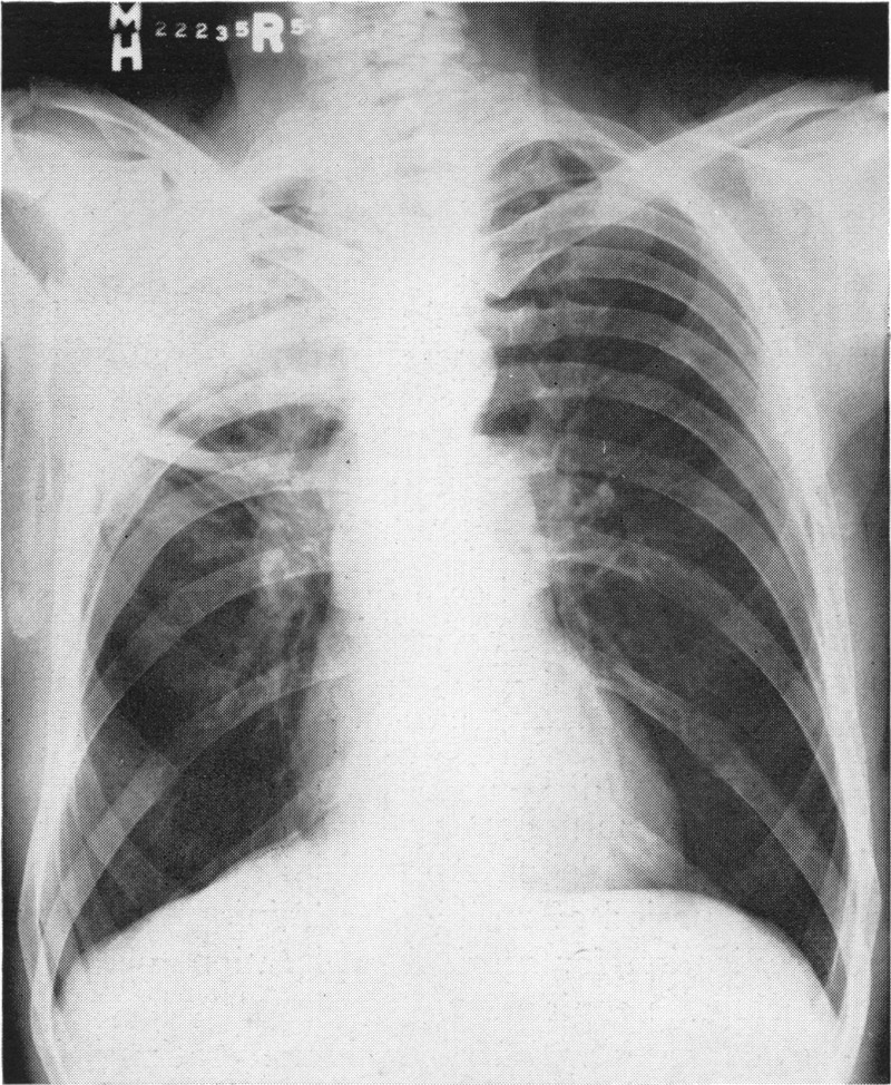 Detail Gambaran Foto Thorax Pneumonia Nomer 35